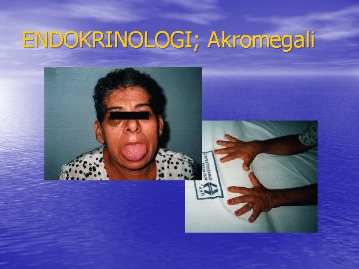 ENDOKRINOLOGI; Akromegali 