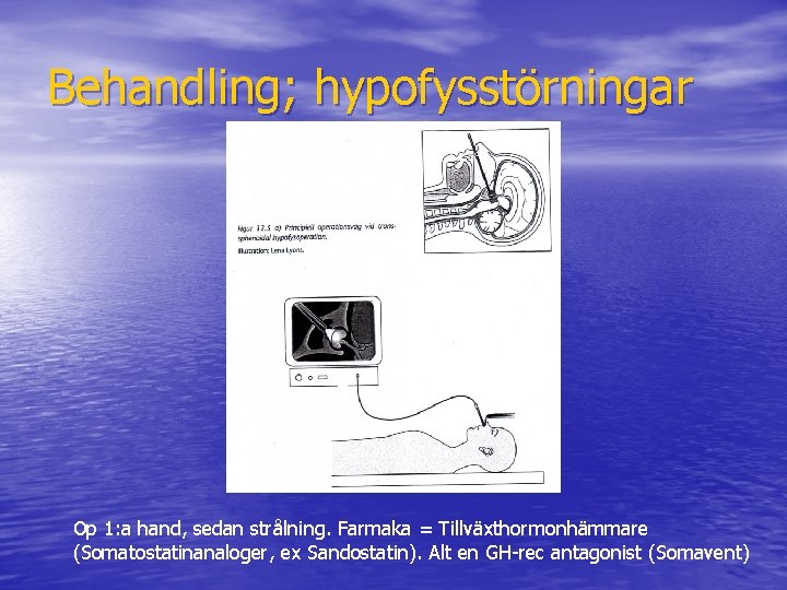 Behandling; hypofysstörningar Op 1: a hand, sedan strålning. Farmaka = Tillväxthormonhämmare (Somatostatinanaloger, ex Sandostatin).