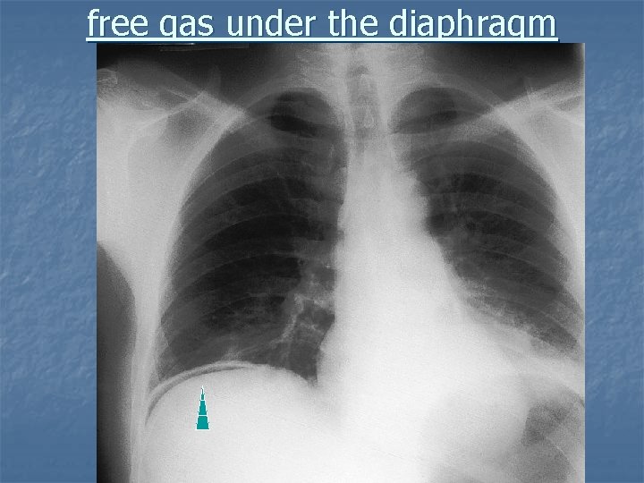 free gas under the diaphragm 