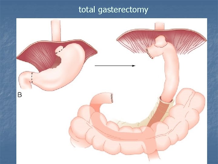 total gasterectomy 