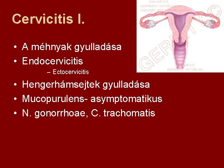 Cervicitis I. • A méhnyak gyulladása • Endocervicitis – Ectocervicitis • Hengerhámsejtek gyulladása •