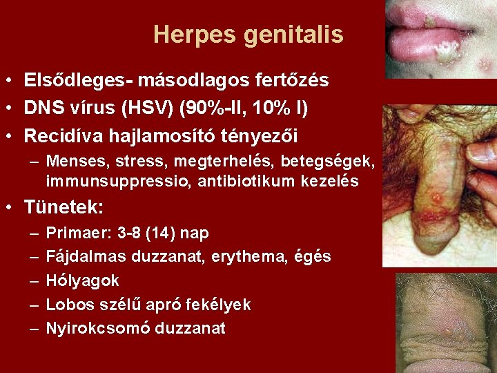 Herpes genitalis • Elsődleges- másodlagos fertőzés • DNS vírus (HSV) (90%-II, 10% I) •