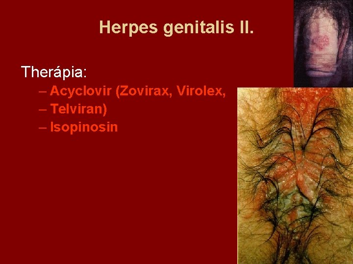 Herpes genitalis II. Therápia: – Acyclovir (Zovirax, Virolex, – Telviran) – Isopinosin 