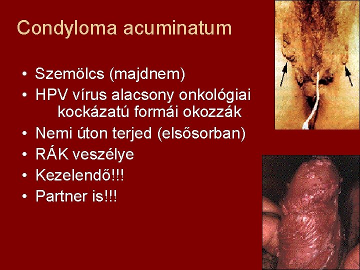 Condyloma acuminatum • Szemölcs (majdnem) • HPV vírus alacsony onkológiai kockázatú formái okozzák •