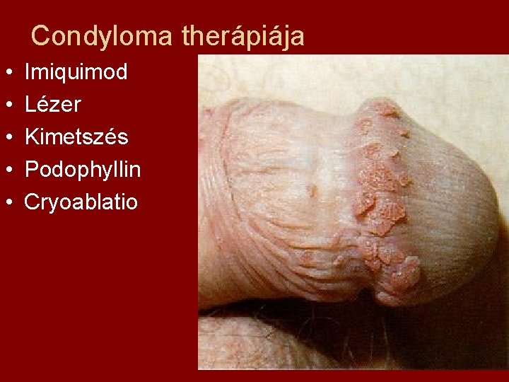 Condyloma therápiája • • • Imiquimod Lézer Kimetszés Podophyllin Cryoablatio 