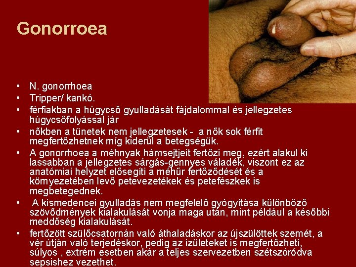 Gonorroea • N. gonorrhoea • Tripper/ kankó. • férfiakban a húgycső gyulladását fájdalommal és