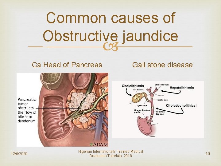 Common causes of Obstructive jaundice Ca Head of Pancreas 12/5/2020 Gall stone disease Nigerian