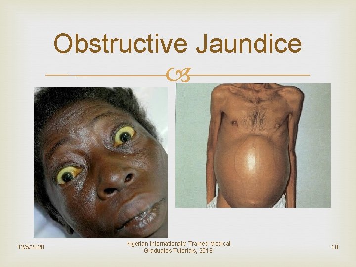 Obstructive Jaundice 12/5/2020 Nigerian Internationally Trained Medical Graduates Tutorials, 2018 18 