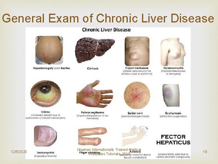 General Exam of Chronic Liver Disease 12/5/2020 Nigerian Internationally Trained Medical Graduates Tutorials, 2018