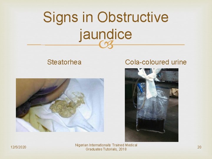 Signs in Obstructive jaundice Steatorhea 12/5/2020 Cola-coloured urine Nigerian Internationally Trained Medical Graduates Tutorials,