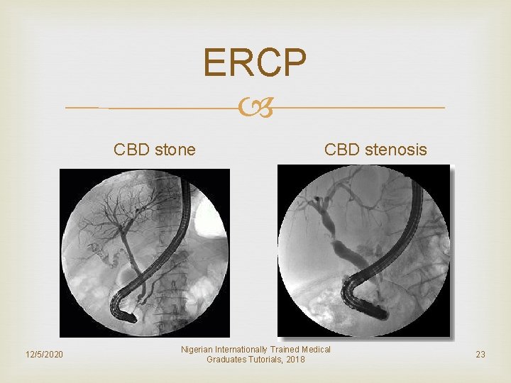 ERCP CBD stone 12/5/2020 CBD stenosis Nigerian Internationally Trained Medical Graduates Tutorials, 2018 23