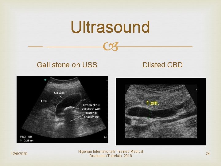 Ultrasound Gall stone on USS 12/5/2020 Dilated CBD Nigerian Internationally Trained Medical Graduates Tutorials,