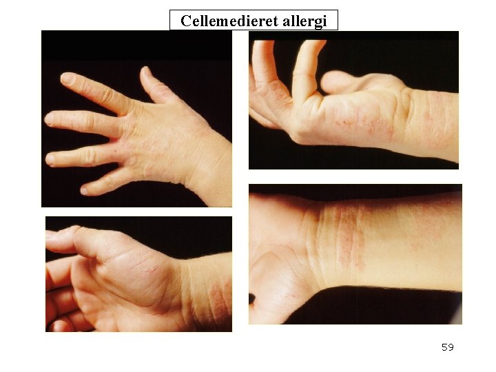 Cellemedieret allergi 59 