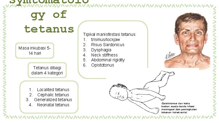 Symtomatolo gy of tetanus Masa inkubasi 514 hari Tetanus dibagi dalam 4 kategori Tipikal