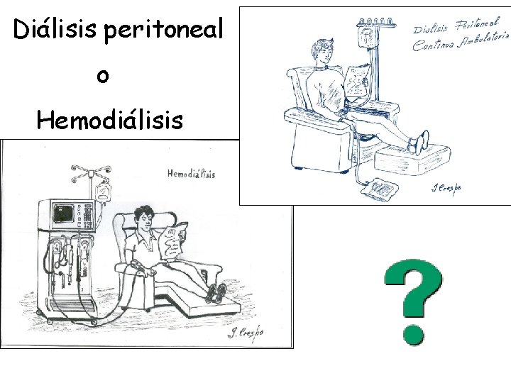 Diálisis peritoneal o Hemodiálisis 