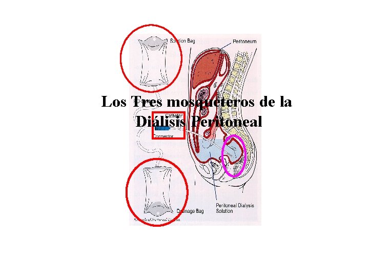 Los Tres mosqueteros de la Diálisis Peritoneal 