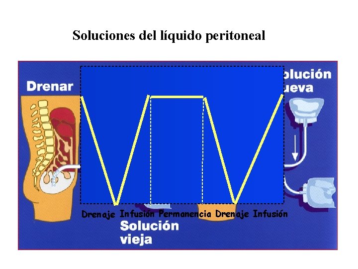 Soluciones del líquido peritoneal Drenaje Infusión Permanencia Drenaje Infusión 