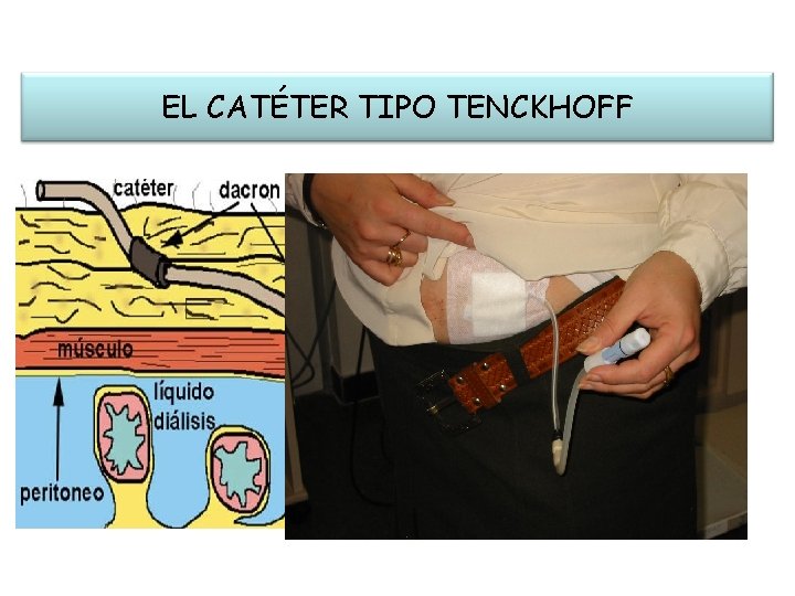 EL CATÉTER TIPO TENCKHOFF 