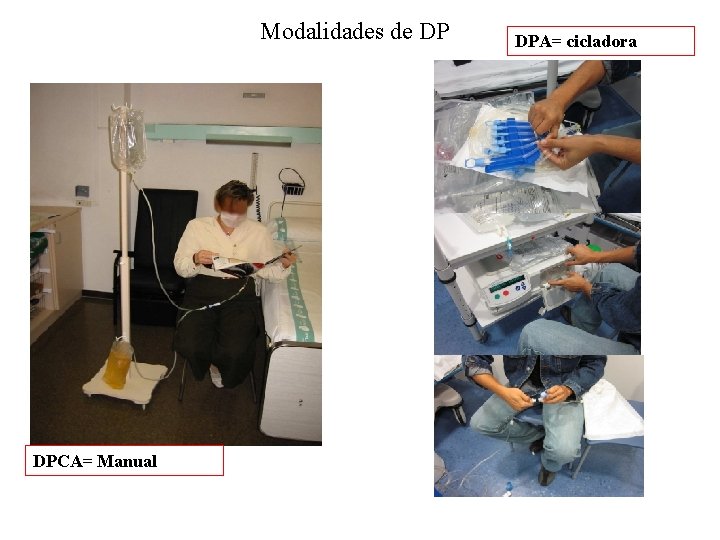 Modalidades de DP DPCA= Manual DPA= cicladora 