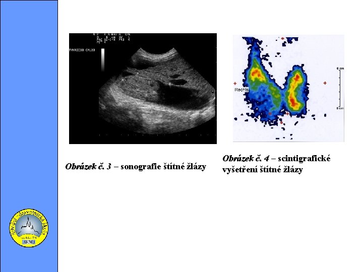 Obrázek č. 3 – Obrázek č. 3 sonografie štítné žlázy Obrázek č. 4 –