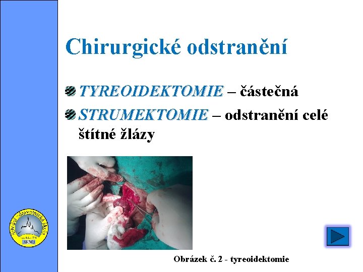 Chirurgické odstranění TYREOIDEKTOMIE – částečná STRUMEKTOMIE – odstranění celé štítné žlázy Obrázek č. 2