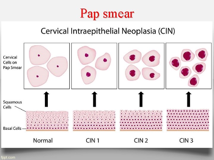 Pap smear 