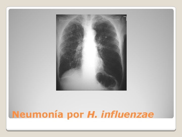 Neumonía por H. influenzae 