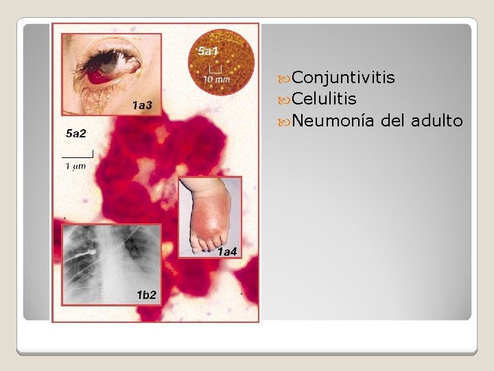  Conjuntivitis Celulitis Neumonía del adulto 