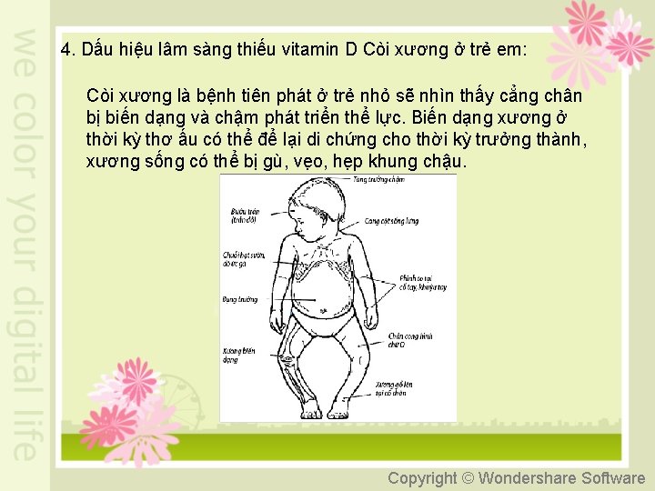 4. Dấu hiệu lâm sàng thiếu vitamin D Còi xương ở trẻ em: Còi