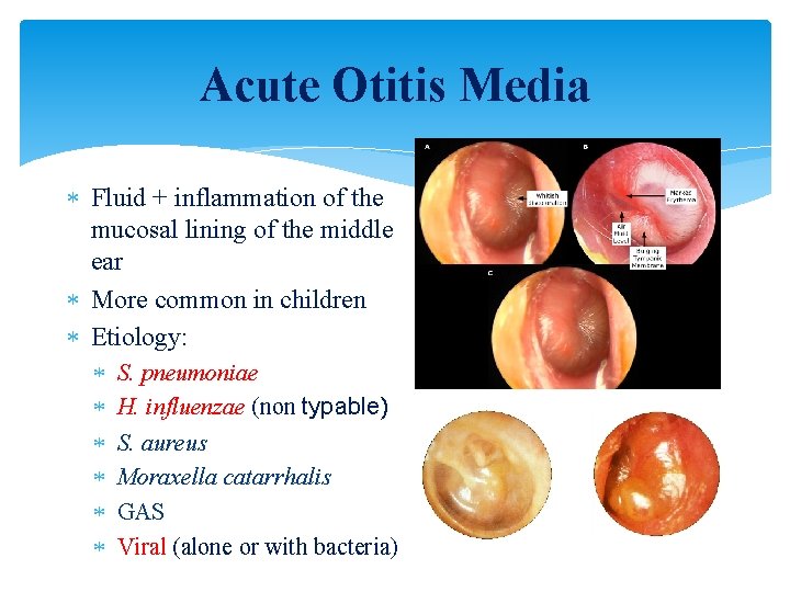 Acute Otitis Media Fluid + inflammation of the mucosal lining of the middle ear