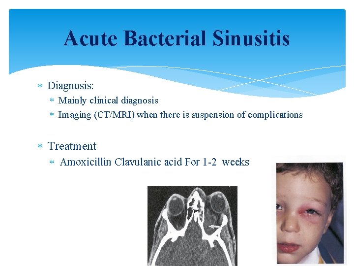 Acute Bacterial Sinusitis Diagnosis: Mainly clinical diagnosis Imaging (CT/MRI) when there is suspension of