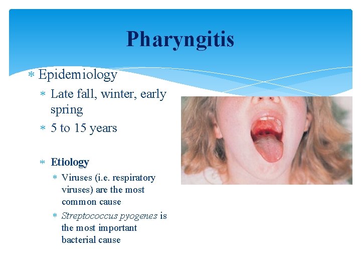 Pharyngitis Epidemiology Late fall, winter, early spring 5 to 15 years Etiology Viruses (i.