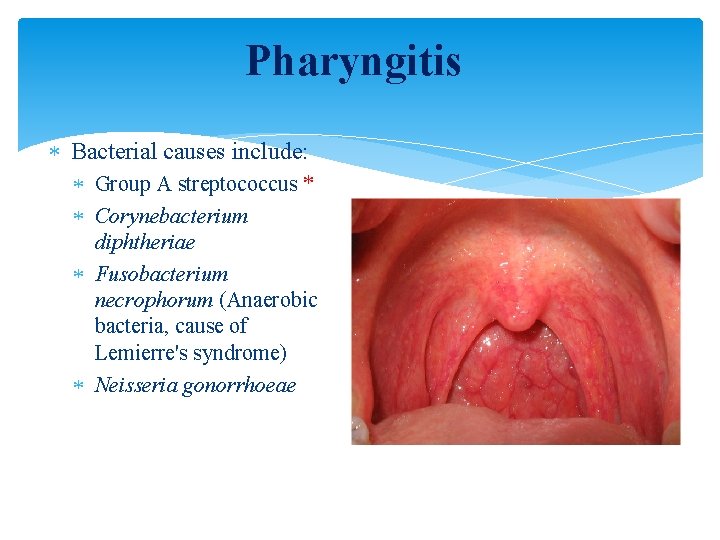 Pharyngitis Bacterial causes include: Group A streptococcus * Corynebacterium diphtheriae Fusobacterium necrophorum (Anaerobic bacteria,