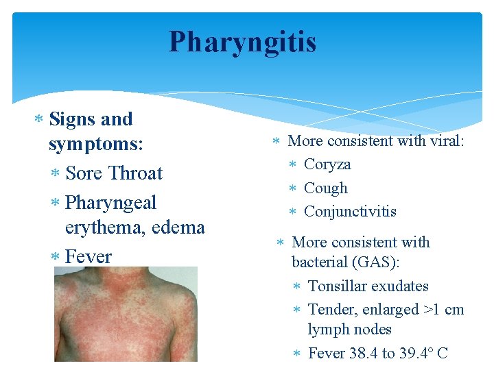 Pharyngitis Signs and symptoms: Sore Throat Pharyngeal erythema, edema Fever More consistent with viral: