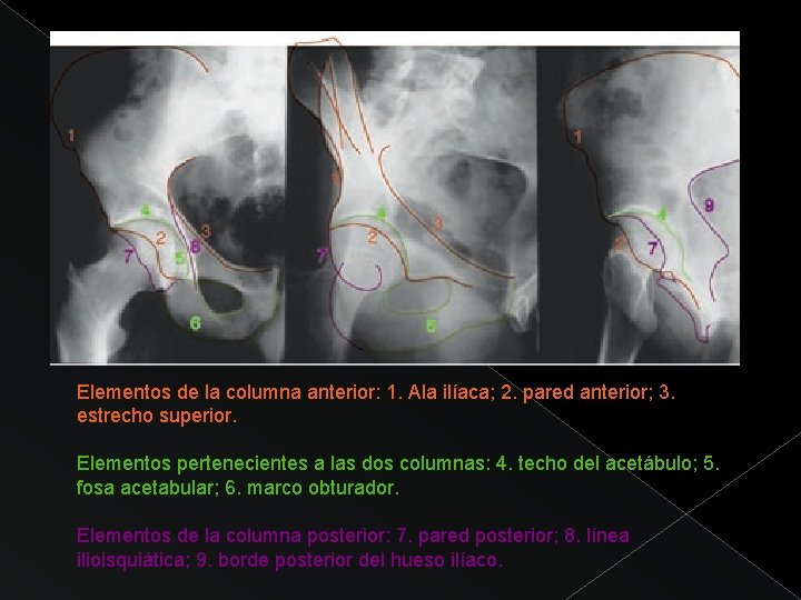 Elementos de la columna anterior: 1. Ala ilíaca; 2. pared anterior; 3. estrecho superior.