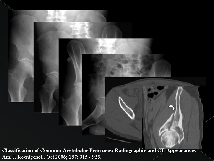 Classification of Common Acetabular Fractures: Radiographic and CT Appearances Am. J. Roentgenol. , Oct