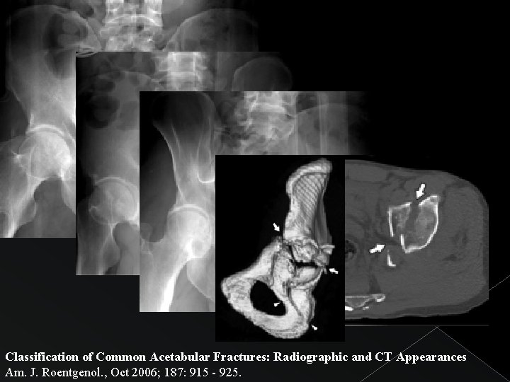 Classification of Common Acetabular Fractures: Radiographic and CT Appearances Am. J. Roentgenol. , Oct