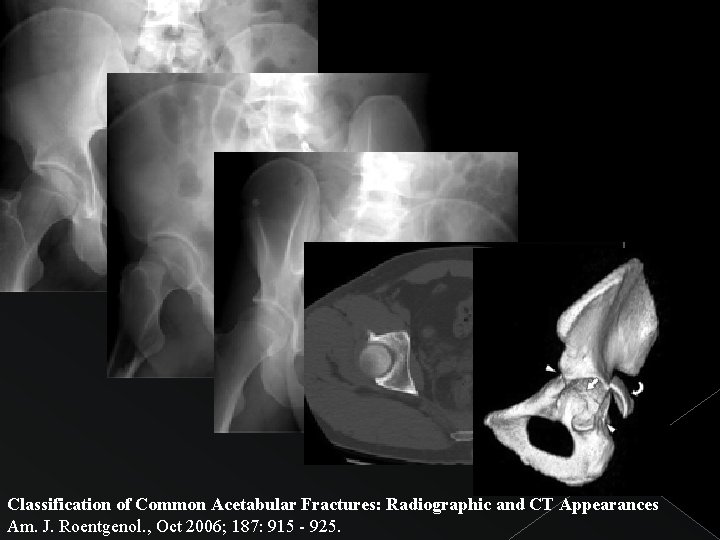 Classification of Common Acetabular Fractures: Radiographic and CT Appearances Am. J. Roentgenol. , Oct