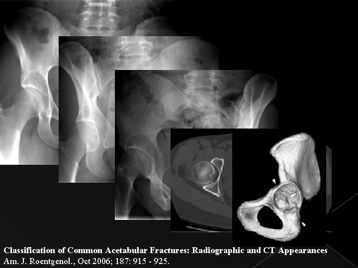 Classification of Common Acetabular Fractures: Radiographic and CT Appearances Am. J. Roentgenol. , Oct