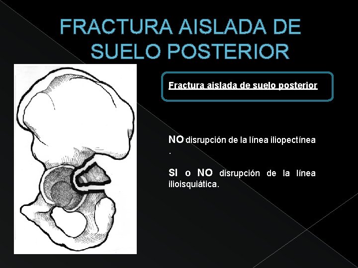 FRACTURA AISLADA DE SUELO POSTERIOR Fractura aislada de suelo posterior NO disrupción de la