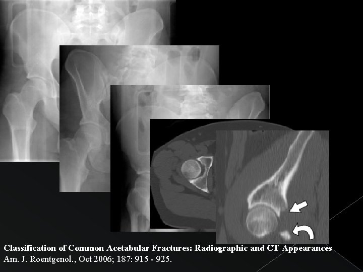 Classification of Common Acetabular Fractures: Radiographic and CT Appearances Am. J. Roentgenol. , Oct