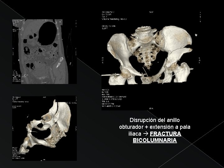 Disrupción del anillo obturador + extensión a pala iliaca FRACTURA BICOLUMNARIA 