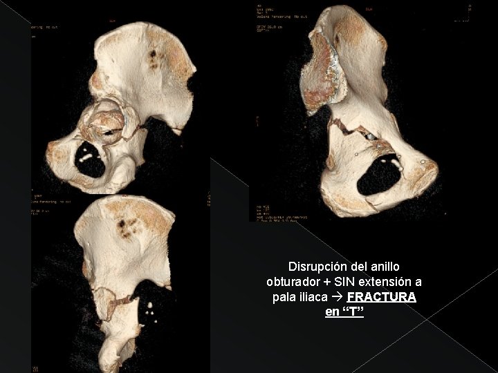 Disrupción del anillo obturador + SIN extensión a pala iliaca FRACTURA en “T” 