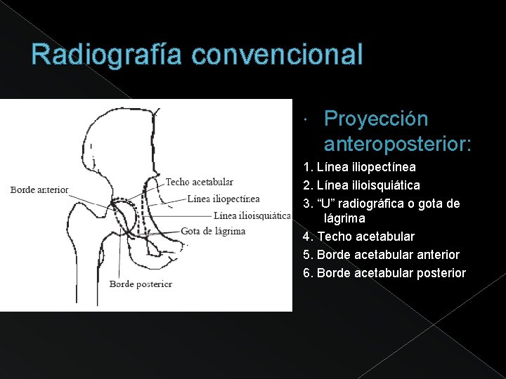 Radiografía convencional Proyección anteroposterior: 1. Línea iliopectínea 2. Línea ilioisquiática 3. “U” radiográfica o
