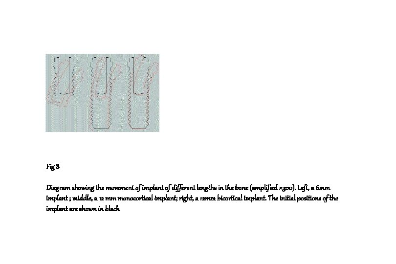 Fig 8 Diagram showing the movement of implant of different lengths in the bone