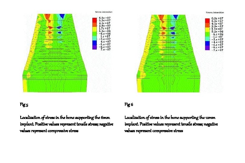 Fig 5 Fig 6 Localization of stress in the bone supporting the 6 mm