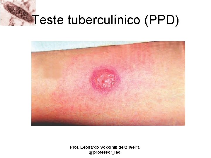 Teste tuberculínico (PPD) Prof. Leonardo Sokolnik de Oliveira @professor_leo 