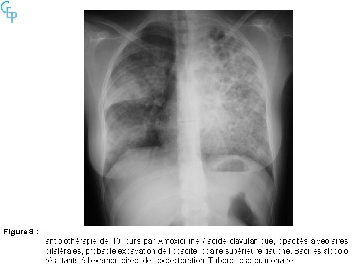 Figure 8 : F antibiothérapie de 10 jours par Amoxicilline / acide clavulanique, opacités