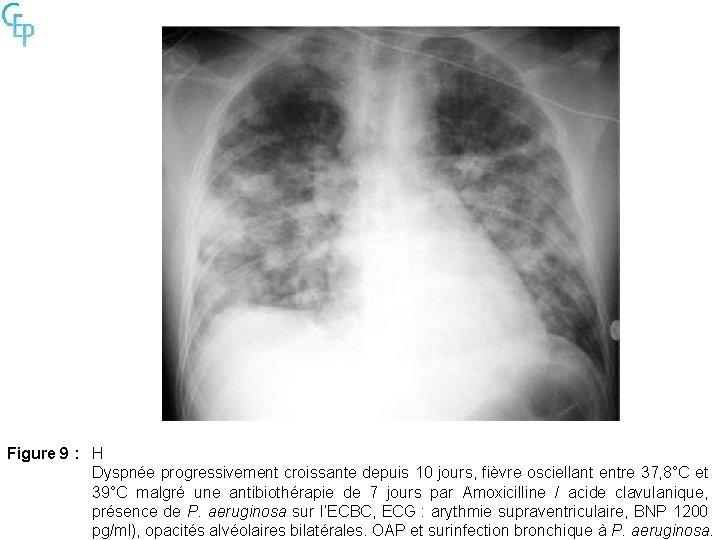 Figure 9 : H Dyspnée progressivement croissante depuis 10 jours, fièvre osciellant entre 37,