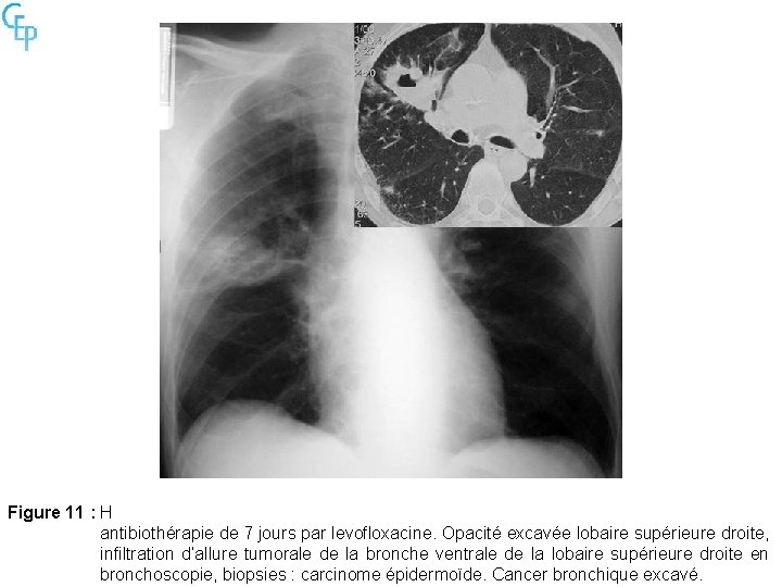 Figure 11 : H antibiothérapie de 7 jours par levofloxacine. Opacité excavée lobaire supérieure